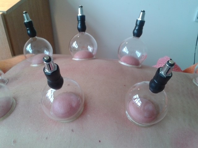 Cupping to restore health
