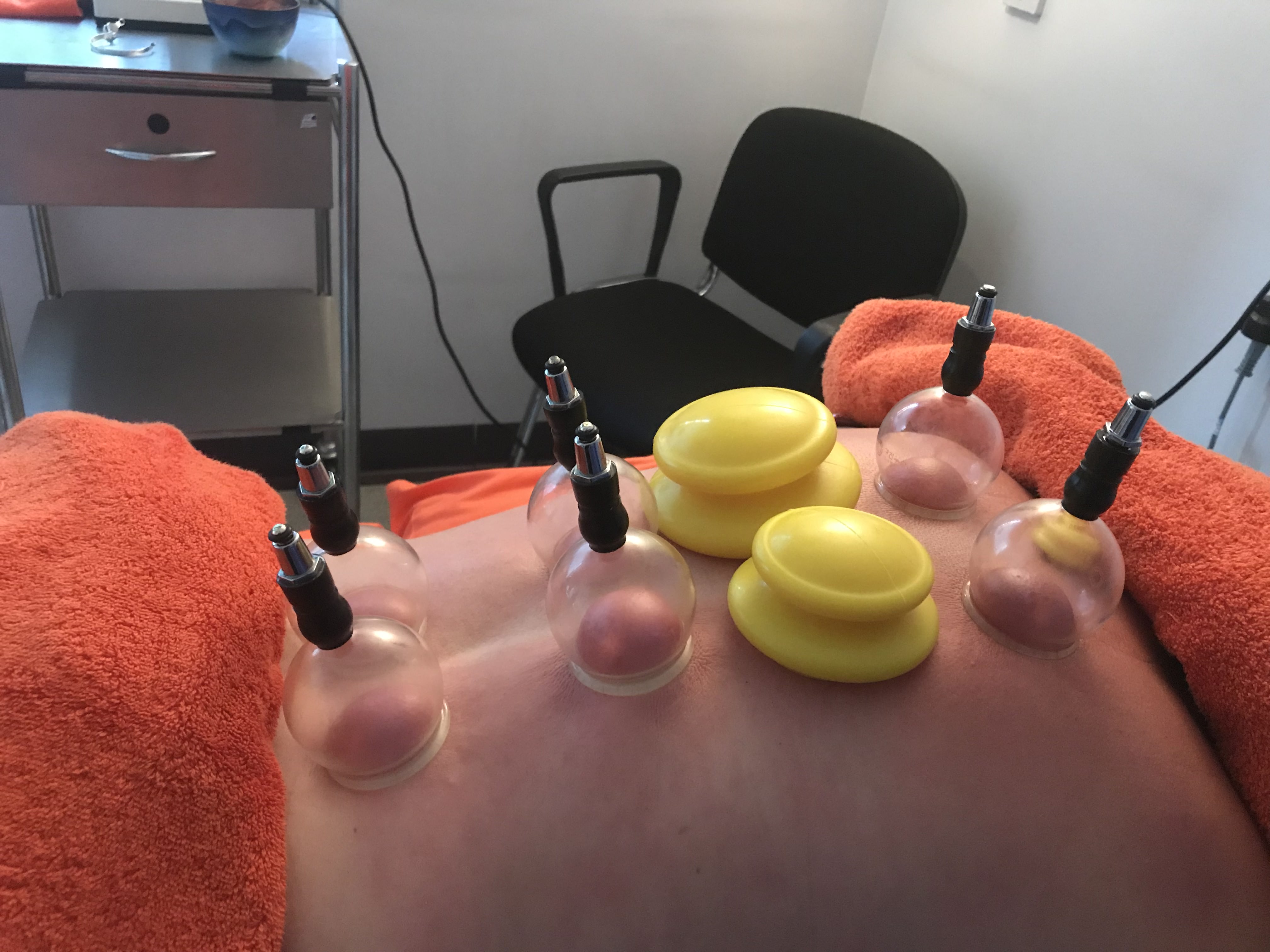 Cupping to nourish Qi and move stagnation